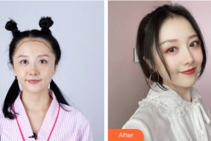 烏魯木齊整形美容醫(yī)院余艷輝整形價格表附植發(fā)案例展示