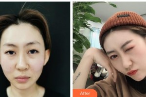 陜西省人民醫(yī)院燒傷整形醫(yī)學(xué)美容科康淑檀整形價格表附埋線提升案例展示
