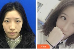 陜西省友誼醫(yī)院醫(yī)學(xué)整形科張永整形價格表附眼部綜合案例展示