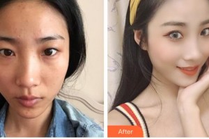 陜西同濟(jì)醫(yī)院激光美容中心武媚整形價格表附眼部綜合案例展示