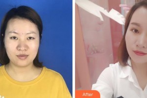 銅川礦務(wù)局中心醫(yī)院燒傷整形科諶煜整形價格表附切開雙眼皮案例展示