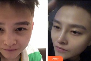 寶雞高新人民醫(yī)院整形美容外科岳能武整形價格表附紅藍(lán)光祛痘案例展示