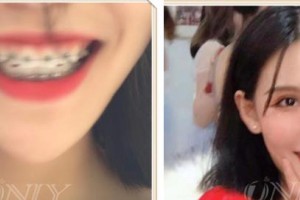 寶雞韓美醫(yī)療美容門診部連野杰整形價格表附金屬托槽矯正案例展示