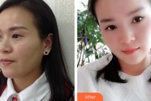 寶雞中心醫(yī)院燒傷整形科王云俠整形價格表附內切祛眼袋案例展示