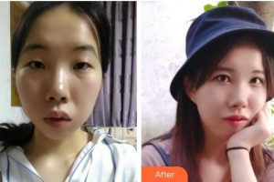 常熟市第二人民醫(yī)院眼科黃正如整形價格表附切開雙眼皮案例展示