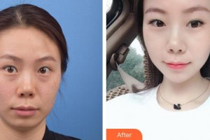 貴州整形美容外科醫(yī)院張智毅整形價(jià)格表附光子嫩膚案例展示