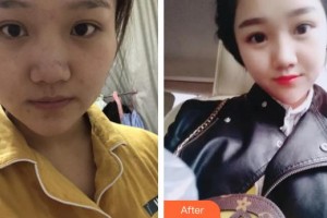 貴州省紅十字會婦女兒童醫(yī)院整形美容中心謝詩思整形價(jià)格表附紅藍(lán)光祛痘案例展示