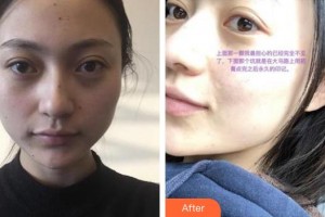 貴州省紅十字會婦女兒童醫(yī)院整形美容中心曾寧川整形價(jià)格表附激光點(diǎn)痣案例展示