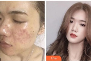 遵義利美康整形美容醫(yī)院章超整形價格表附紅藍光祛痘案例展示