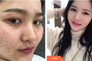 遵義喬雅菲醫(yī)療美容門診部羅碧強整形價格表附紅藍光祛痘案例展示