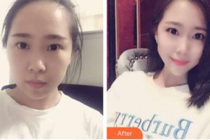 畢節(jié)西南皮膚病醫(yī)院郭惠中整形價(jià)格表附切開(kāi)雙眼皮案例展示