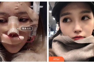 青?？等A整形醫(yī)院蔡志昆整形價(jià)格表附鼻部綜合案例展示