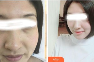 張家港康麗?？漆t(yī)院整形美容外科陸玉萍整形價格表附美白嫩膚案例展示
