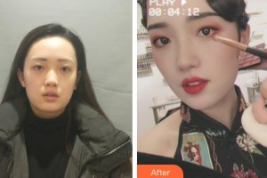 武警廣西總隊醫(yī)院醫(yī)學整形美容中心趙福德整形價格表附熱瑪吉案例展示
