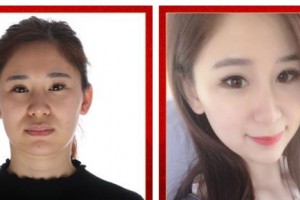 武警廣西總隊醫(yī)院醫(yī)學整形美容中心張潮整形價格表附埋線提升案例展示