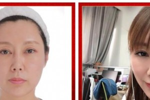 武警廣西總隊醫(yī)院醫(yī)學整形美容中心王朝生 教授整形價格表附埋線提升案例展示