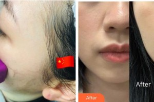 武警廣西總隊醫(yī)院醫(yī)學整形美容中心張樹芳 整形價格表附熱瑪吉案例展示