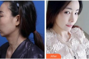 廣西醫(yī)科大學第一附屬醫(yī)院整形美容科黃安林整形價格表附鼻修復案例展示