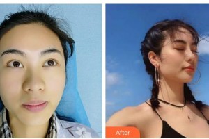 廣西醫(yī)科大學第一附屬醫(yī)院整形美容科劉達恩整形價格表附鼻部綜合案例展示