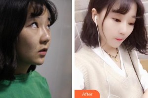 廣西中醫(yī)藥大學附屬瑞康醫(yī)院整形美容中心郭應(yīng)信整形價格表附切開雙眼皮案例展示