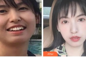廣西中醫(yī)藥大學附屬瑞康醫(yī)院整形美容中心吳偉民整形價格表附金屬托槽矯正案例展示