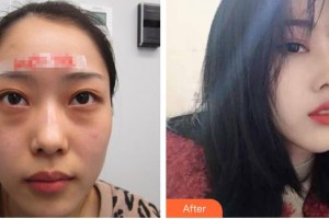 柳州愛爾眼科醫(yī)院王冬梅整形價格表附眼部修復案例展示