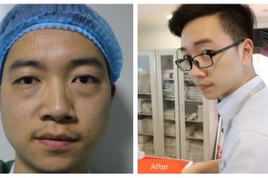 柳州愛爾眼科醫(yī)院陽昇整形價格表附激光去眼袋案例展示