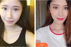 桂林醫(yī)學(xué)院第二附屬醫(yī)院眼科秦程整形價(jià)格表附切開(kāi)雙眼皮案例展示