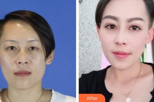 桂林市中醫(yī)醫(yī)院眼科楊小凡整形價(jià)格表附切開雙眼皮案例展示