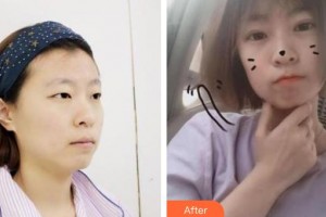 梧州市工人醫(yī)院眼科湯蘭蘭整形價格表附切開雙眼皮案例展示