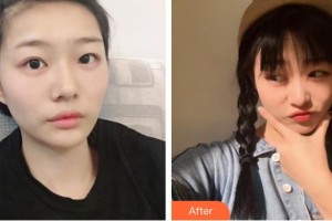 梧州市工人醫(yī)院眼科黃子伲整形價格表附眼部綜合案例展示