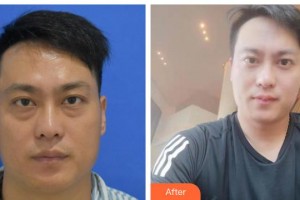 北海博鏵醫(yī)院整形美容中心趙弘宇整形價格表附激光去眼袋案例展示