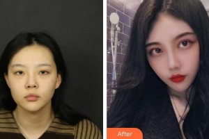 北海韓美醫(yī)療美容門診部楊雙輝整形價(jià)格表附埋線雙眼皮案例展示
