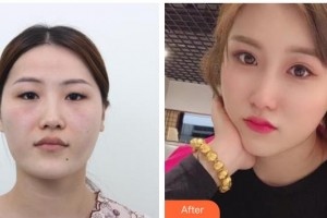 北海博鏵醫(yī)院整形美容中心余德慶整形價(jià)格表附切開雙眼皮案例展示