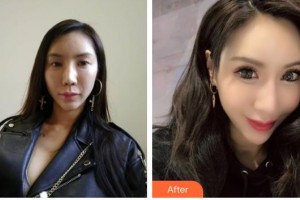 貴港愛爾眼科醫(yī)院黃瓊整形價格表附切開雙眼皮案例展示