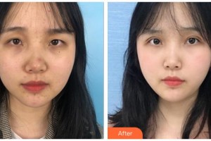 玉林華美整形美容醫(yī)院樸洪權(quán)整形價格表附眼部綜合案例展示