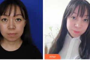 玉林愛(ài)爾眼科醫(yī)院黃玫整形價(jià)格表附外切祛眼袋案例展示