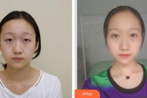 玉林時(shí)光醫(yī)療美容醫(yī)院陳鴻整形價(jià)格表附切開(kāi)雙眼皮案例展示