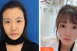 ?？跂|湖醫(yī)學(xué)美容整形醫(yī)院張文其整形價(jià)格表附去痘印痘坑案例展示