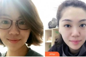 ?？诖揸匚尼t(yī)療美容診所崔曦文整形價(jià)格表附光子嫩膚案例展示