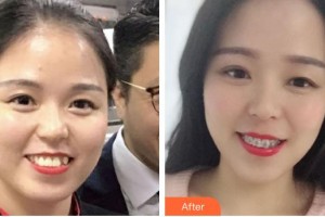 海口杭牙維信口腔門(mén)診部李娜住院醫(yī)師整形價(jià)格表附自鎖托槽矯正案例展示