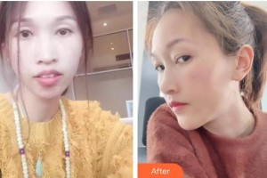 海口德恩口腔門(mén)診部朱平整形價(jià)格表附金屬托槽矯正案例展示