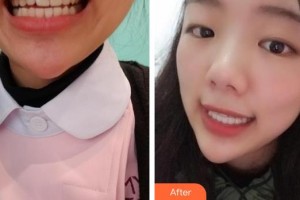 海口杭牙維信口腔門(mén)診部樸光裕整形價(jià)格表附隱形托槽矯正案例展示