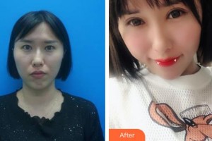 ?？诩t妝尚醫(yī)療美容門(mén)診部羅勇整形價(jià)格表附內(nèi)切祛眼袋案例展示