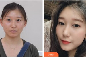 ?？诩t妝尚醫(yī)療美容門(mén)診部袁兆周整形價(jià)格表附切開(kāi)雙眼皮案例展示