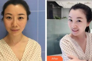 ?？诩t妝尚醫(yī)療美容門(mén)診部李楠整形價(jià)格表附埋線提升案例展示