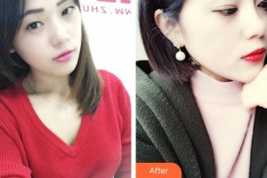 揚州第一人民醫(yī)院整形美容科陳菊萍整形價格表附無針水光案例展示