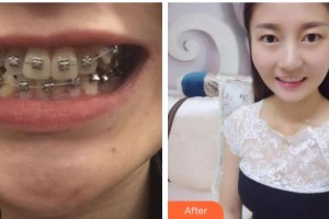 揚州施爾美醫(yī)療美容醫(yī)院石增玲整形價格表附金屬托槽矯正案例展示
