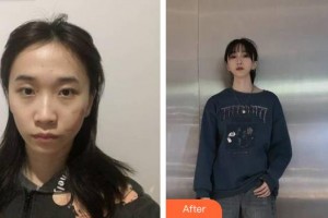 荊州華美整形美容醫(yī)院董巖巖整形價(jià)格表附微創(chuàng)疤痕修復(fù)案例展示