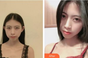 荊州華美整形美容醫(yī)院倪彬整形價(jià)格表附切開(kāi)雙眼皮案例展示